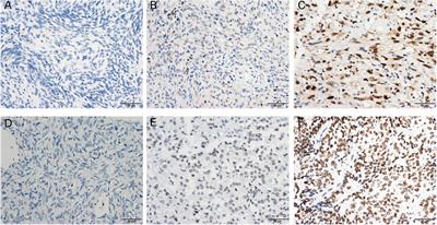 Enhancer of zeste homolog 2 is a negative prognostic biomarker and correlated with immune infiltrates in meningioma
